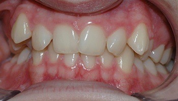 Closeup of smile with crossbite