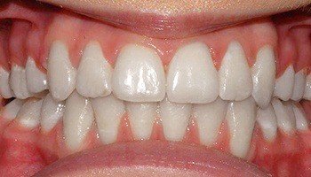 Closeup of straight teeth