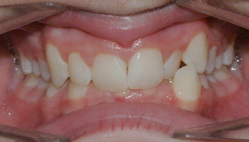 Closeup of severe overbite