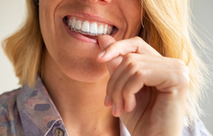 Woman with blond hair pushing Invisalign over upper arch