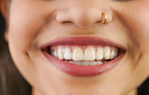Closeup of woman’s smile with Invisalign barely visible