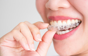 Nose-to-chin ¾ profile view of woman removing top row of Invisalign