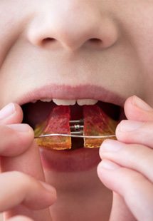 a child using an orthodontic appliance near Keene