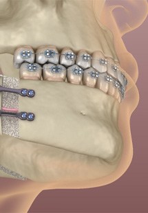 an illustration of orthognathic surgery near Keene