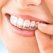 Patient placing teeth whitening tray