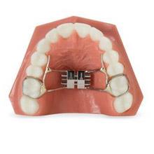 Palatal expander