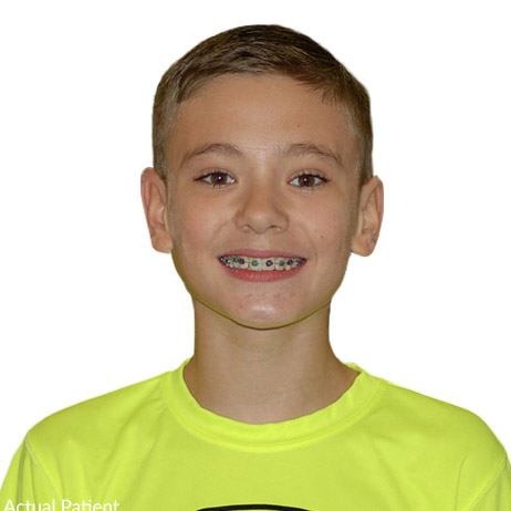 Young boy with braces