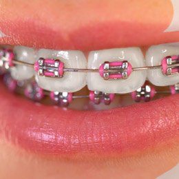 Smile with traditional braces