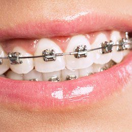 Orthodontist in Cleburne, Braces