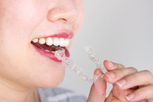 woman smiling inserting Invisalign trays 