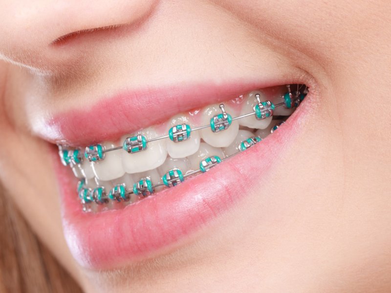 Closeup of girl with braces smiling