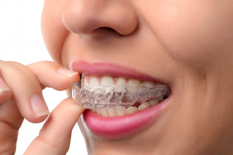 Invisalign trays fixing a patient’s bite problems